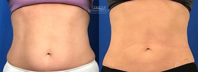 CoolSculpting for Lower Abdomen
