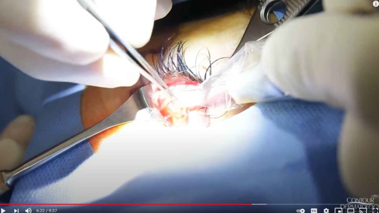 n this episode of Best of Both Worlds, Dr. Jochen performs a lower blepharoplasty on our patient Shannon.