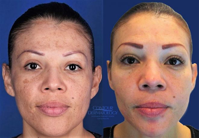 Chemical Peel Before and After