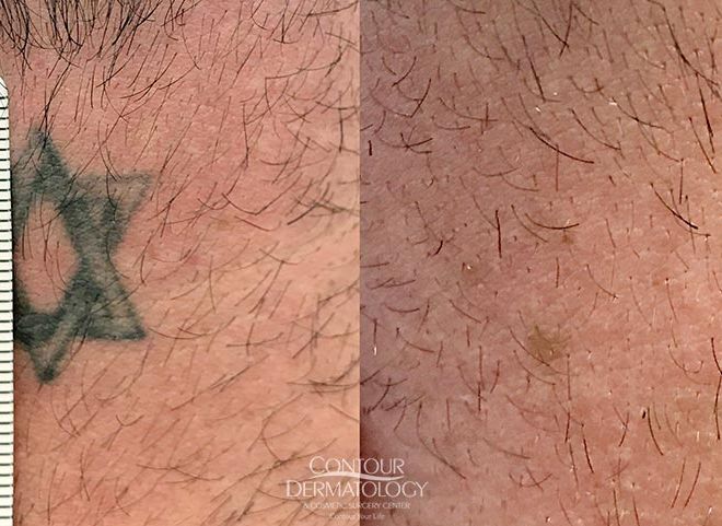 Tattoo Removal, Tattoo Off – Latest Technology & Technique