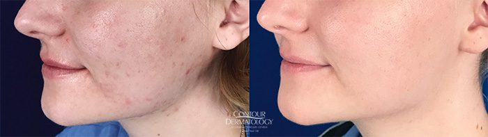 Accutane and SmoothBeam Laser