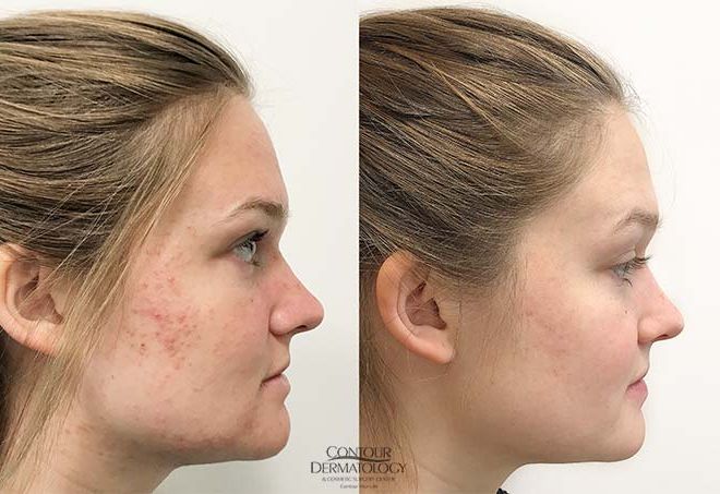 Accutane, Before & After