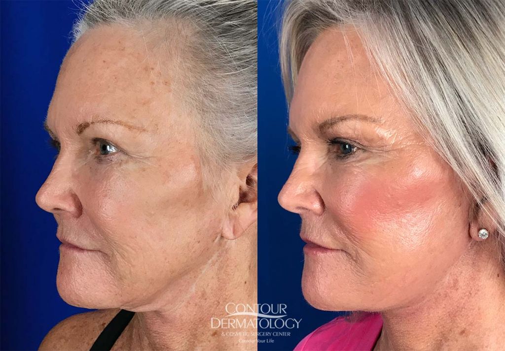 Mini Facelift, 1 month after