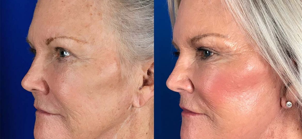 Mini Facelift, 1 month after