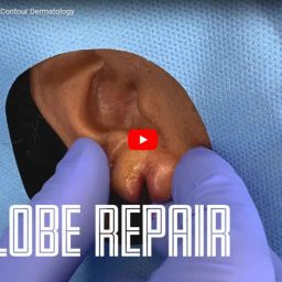 Dr. Jochen goes into action as he performs an earlobe repair surgery. There are plenty of reasons why patients come in for this procedure like stretched earlobes because of heavy earrings.