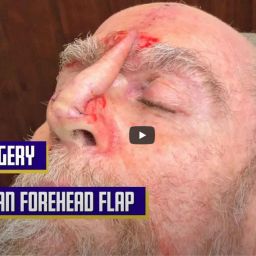 Dr. Jochen performs a Paramedian Forehead Flap, also called interpolated flap, to close a defect on the tip of the nose after a Mohs Surgery, Part 2.