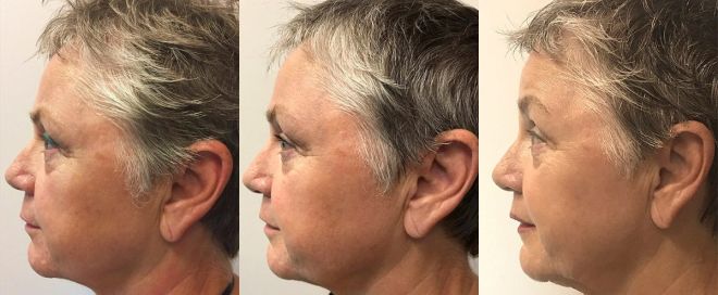 20180208-Triniti-Face-5_Treatments-Left-Before-After-lg-1