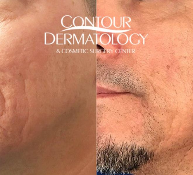 Acne Scar Treatment with Fraxel Laser, Sublative, Subscision and Filler.