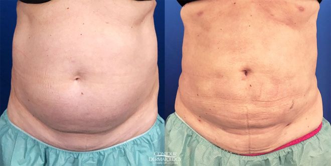 Liposculpture Abdomen, Flanks, Groin, 70 Year Old Female, 1 Month After