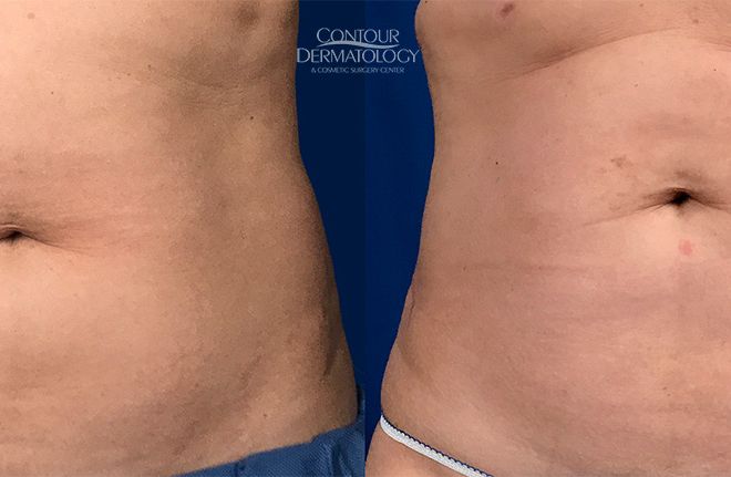 Liposculpture Flanks, 6 Months After, 51 Year Old Female