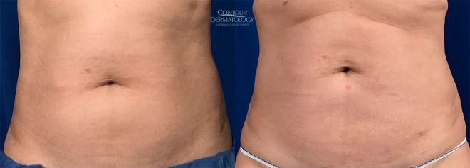 Liposculpture Flanks, 6 Months After, 51 Year Old Female