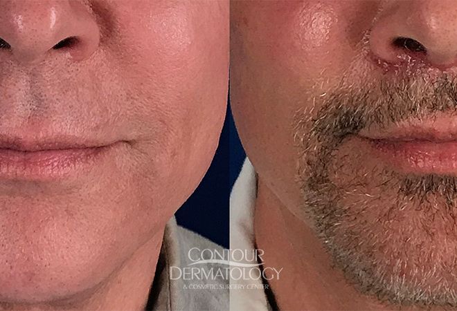 Lip Lift, 65 Year Old Male, 1 Month After