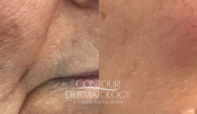 PicoWay Resolve Laser , 77 Year Old Female, 6 Months After