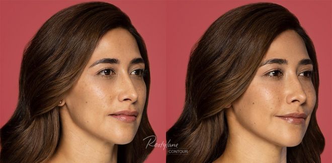 Restylane Contour Before and After Photo