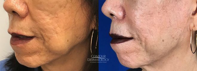 Buccal Fat Reduction, Kybella, 5 vials to jowls, 6 months after treatment, 67 year old female