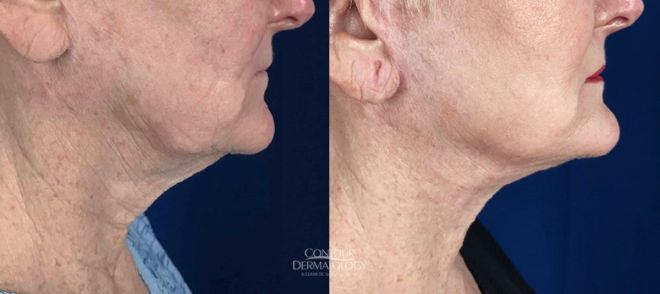 Mini-Facelift, 4 months After