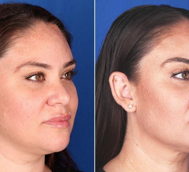 Profound before and after results for the face and neck