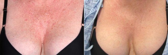 Triniti-Chest-Before-After-lg