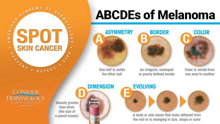 Types of Skin Cancer and how to detect them.
