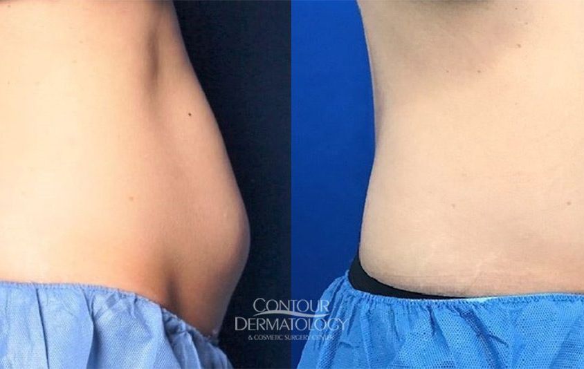 CoolSculpting Photo Gallery