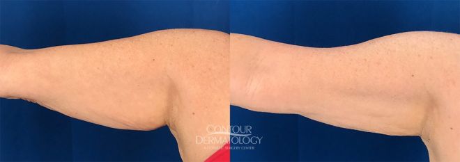 CoolSculpting for Arms, 2 treatments