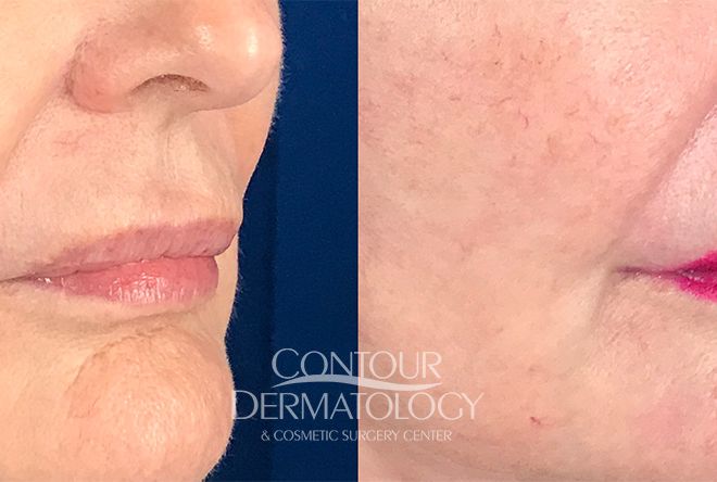 Lip Lift, 60 Year Old Female, 3 Weeks After