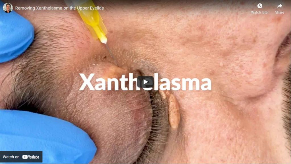 Xanthelasma may also be an early warning sign of an underyling issue or that cholesterol has started to build up in your blood vessels.