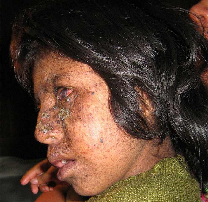 Xeroderma Pigmentosum | Contour Dermatology Xeroderma Pigmentosum