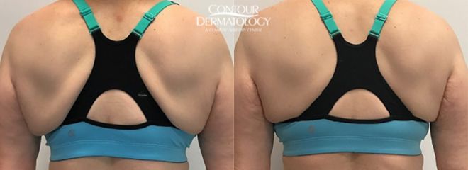 VelaShape III for Back Before and After
