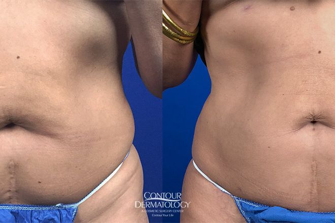 Liposuction for Abdomen, Before and After