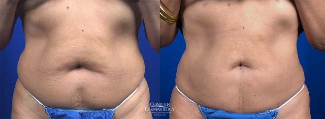 Liposuction for Abdomen, Before and After