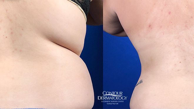 Liposuction for Abdomen and Flanks, Before and After