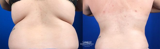 Liposuction for Abdomen and Flanks, Before and After