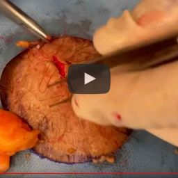 Dr. Timothy Jochen extracts a lipoma that looks like a lobster!