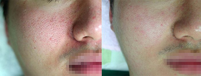 Lutronic Action II, Large Pores, Before & After | Contour Dermatology Lutronic Action II, Large Pores, Before & After