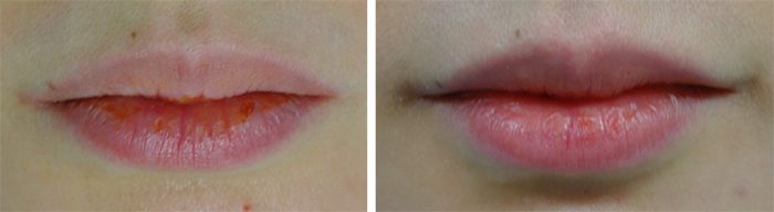 Lutronic Action II, Lip Tint Treatment, Before & After