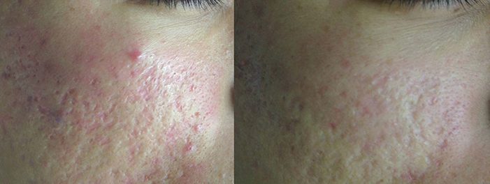 Lutronic Action II, Acne Scars, Before & After