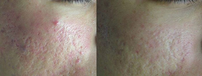 20200311-lutronic-acnescars-web | Contour Dermatology Lutronic Action II, Acne Scars, Before & After