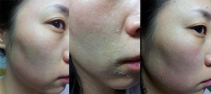 Lutronic II Erbium | Contour Dermatology Lutronic II Erbium