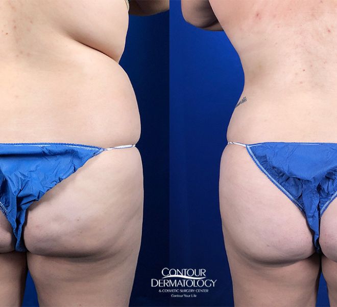 Liposuction for the Abdomen and Flanks with Fat Transfer to the Buttocks