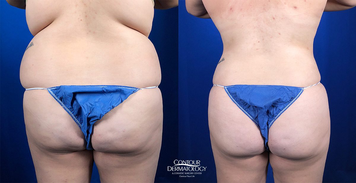 Liposuction for the Abdomen and Flanks with Fat Transfer to the Buttocks - Female