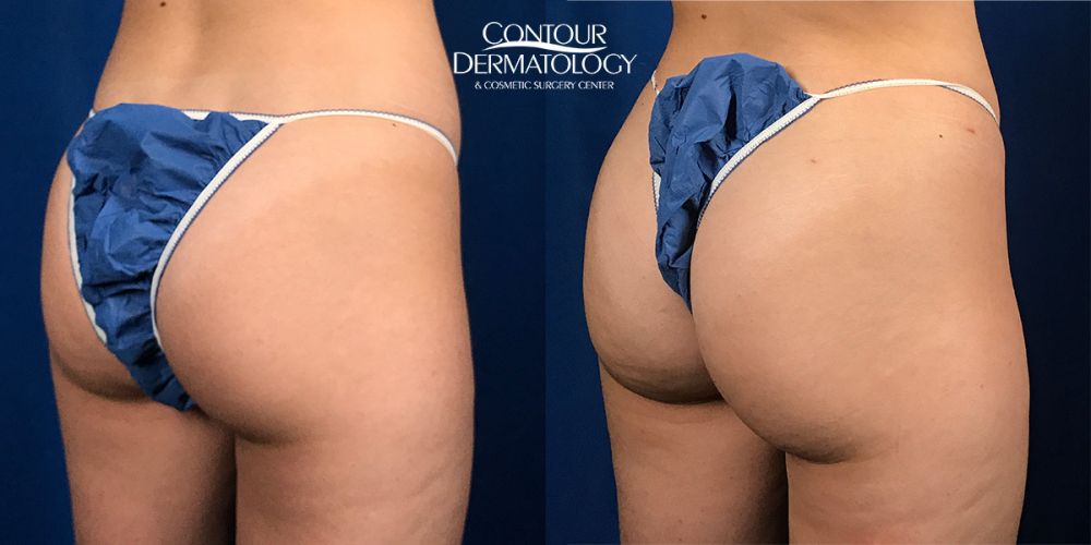 Brazilian Butt Lift – Fat Transfer to the Buttocks – Right Side View