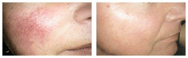 Vbeam Perfecta Before and After