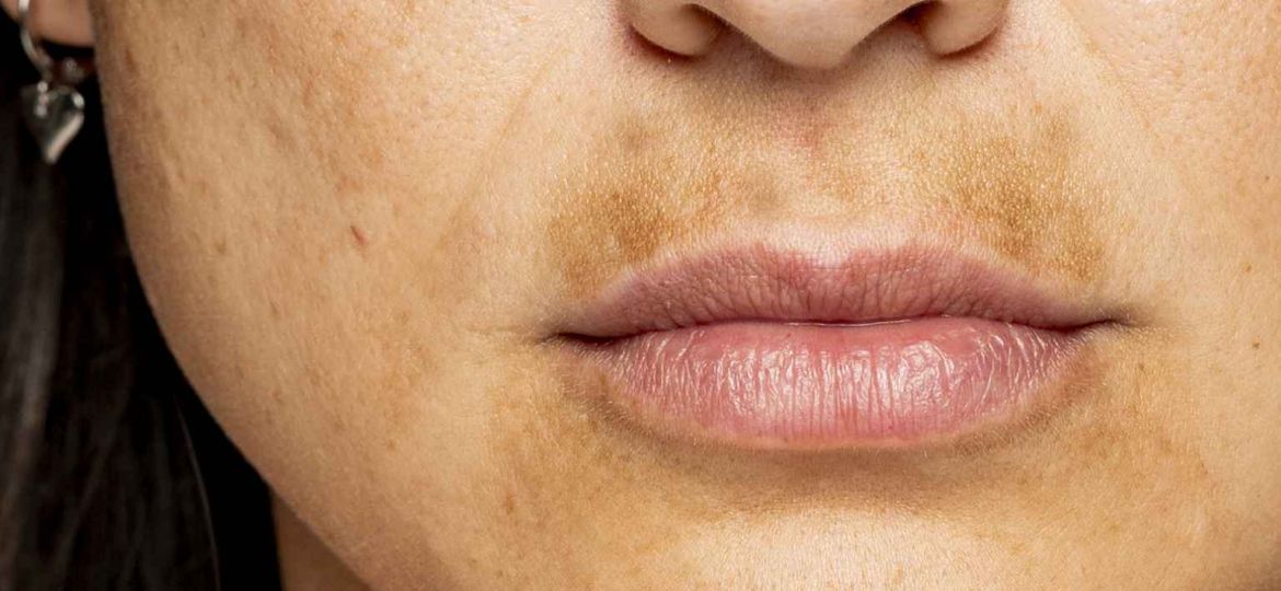 So many people are embarrassed by pigment above their lip, humorously called Melasma Mustache or Sun Mustache. A darkened upper lip is not painful but can make you self-conscious and emotionally upset.