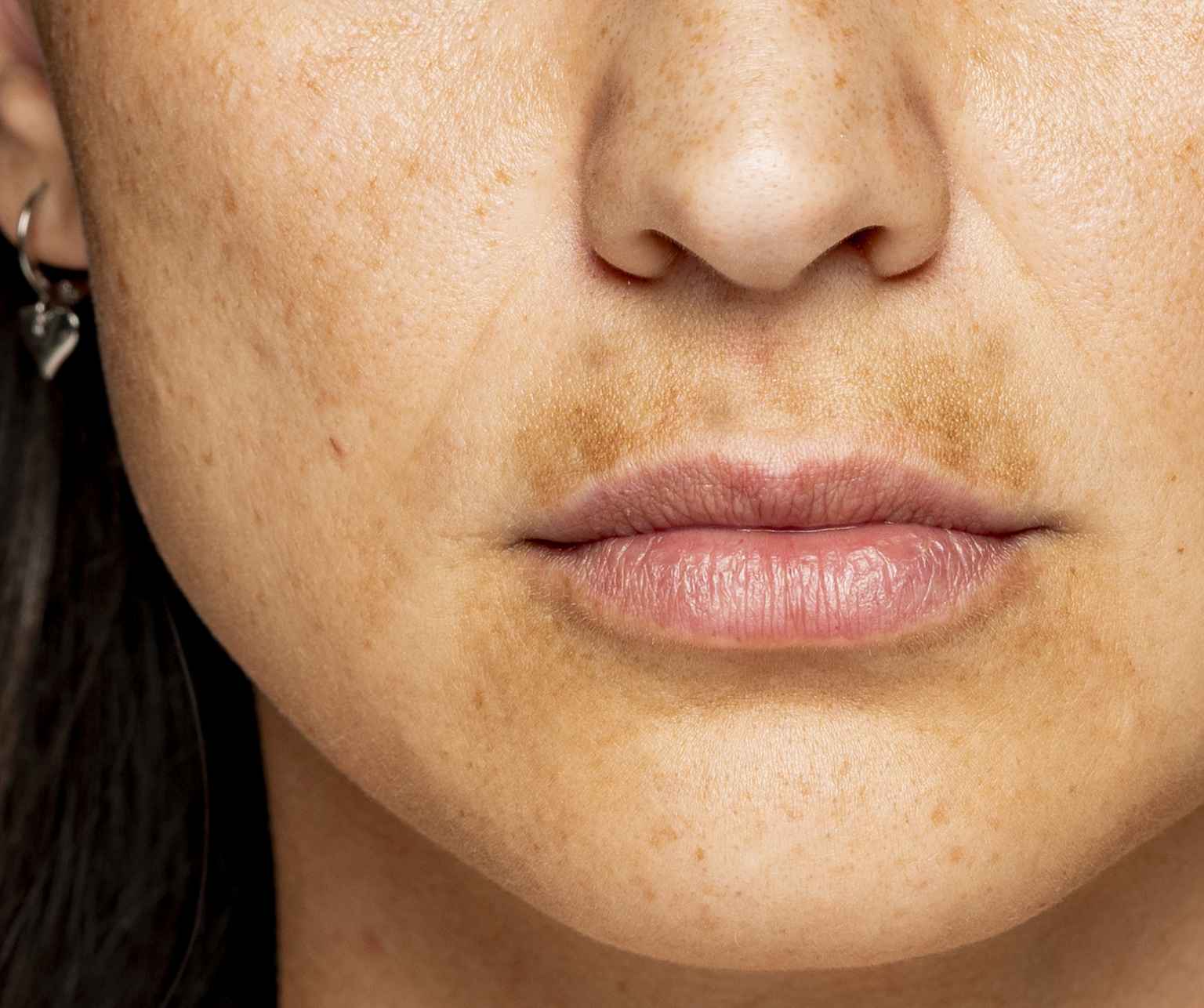 So many people are embarrassed by pigment above their lip, humorously called Melasma Mustache or Sun Mustache. A darkened upper lip is not painful but can make you self-conscious and emotionally upset.