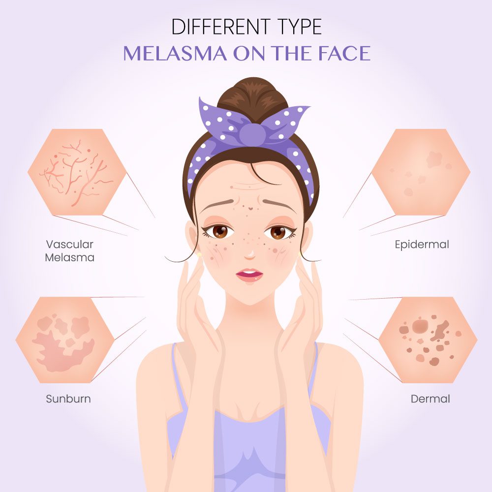 Different Types of Melasma on the Face