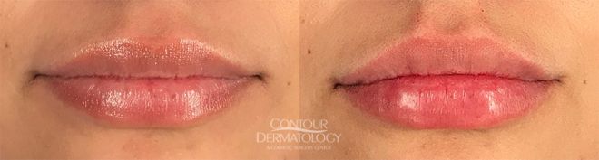 Restylane Defyne for Lips, before and Immediately after