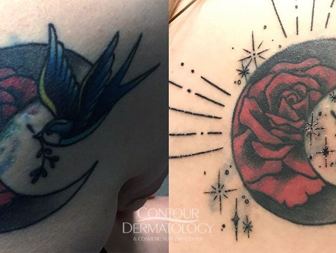 Pico Tattoo Removal 3 treatments cover up