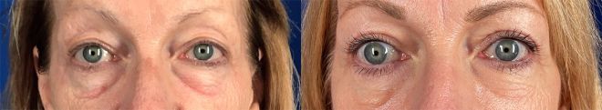 blepharoplasty upper and lower with Co2 Laser