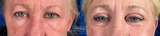 blepharoplasty upper and lower eyelids with co2